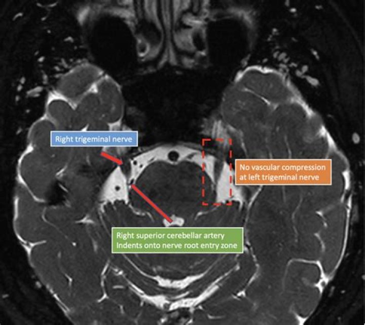 Do inflamed nerves show up on MRI?