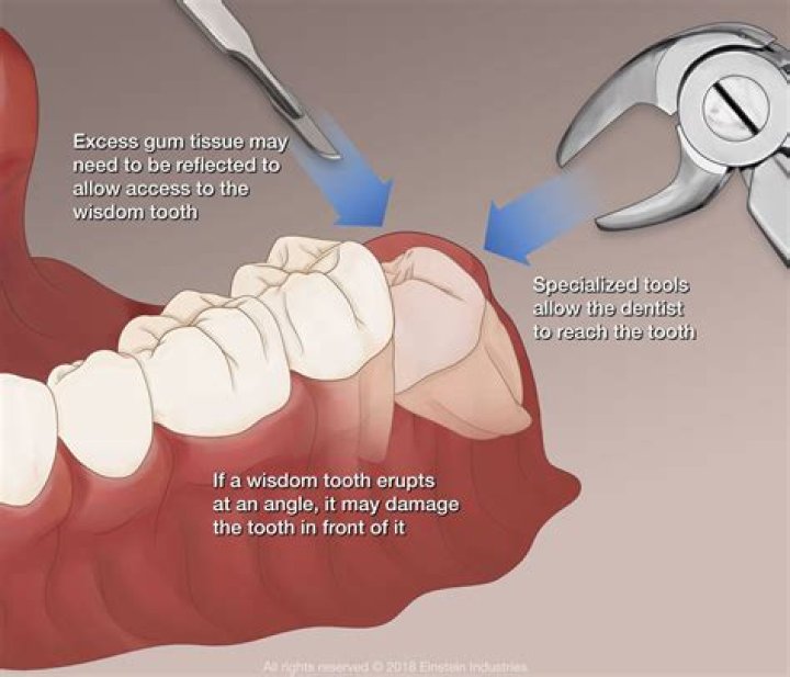 Do models remove their wisdom teeth?