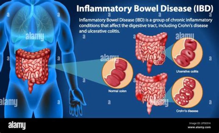 Is corn inflammatory? - WeBlogy