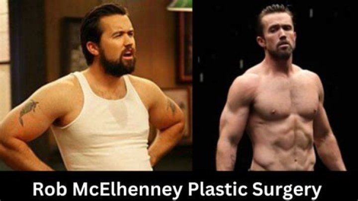 Rob McElhenney's Plastic Surgery Revelation